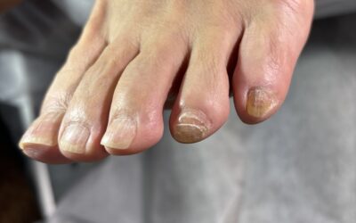 爪が折れた!そんな時に使えるコレの使い方